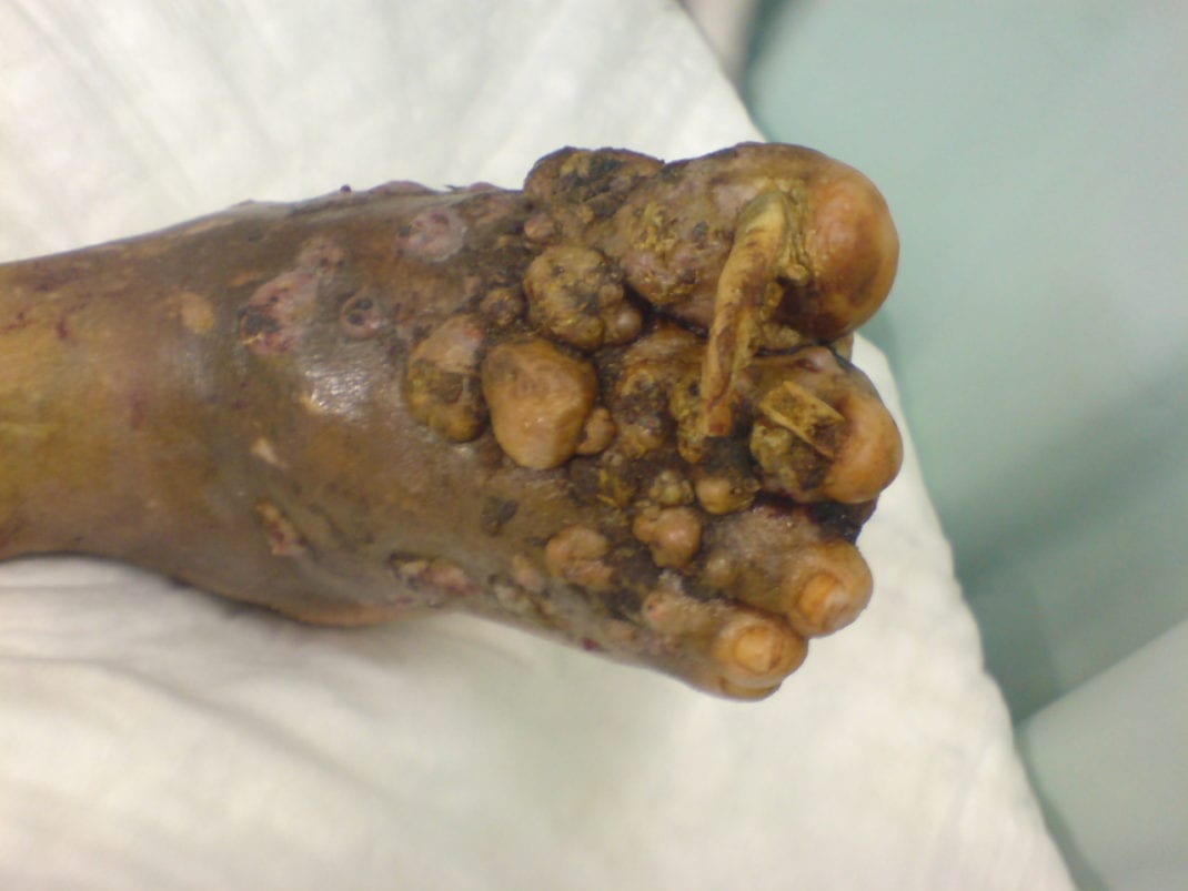 most scary diseases: Eumycetoma